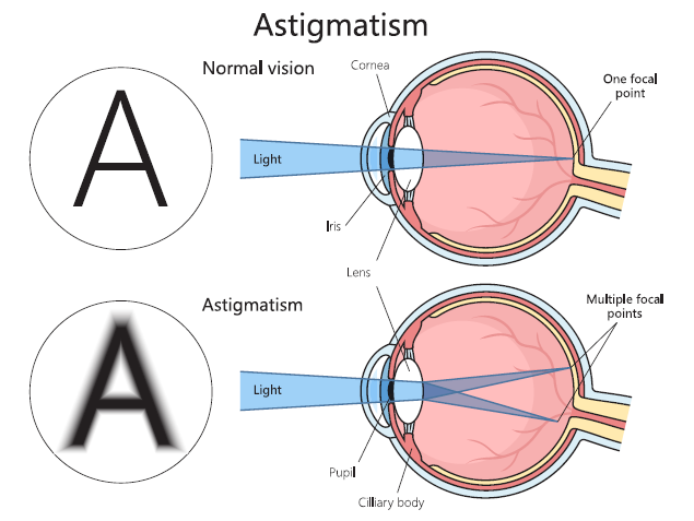 Astigmatism Diagram